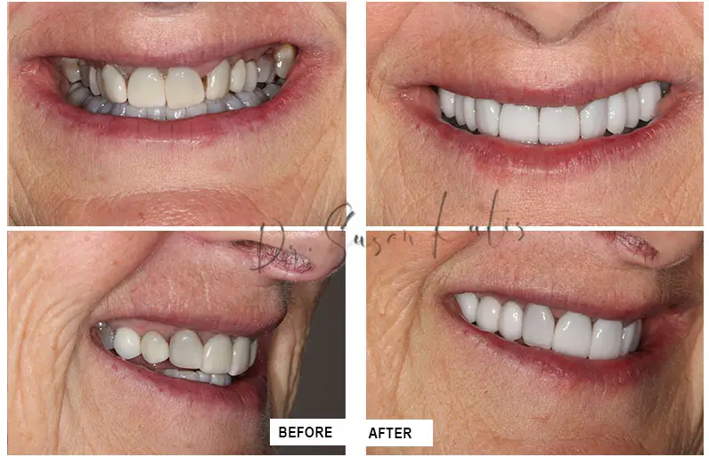 Tetracycline Staining LIttleton