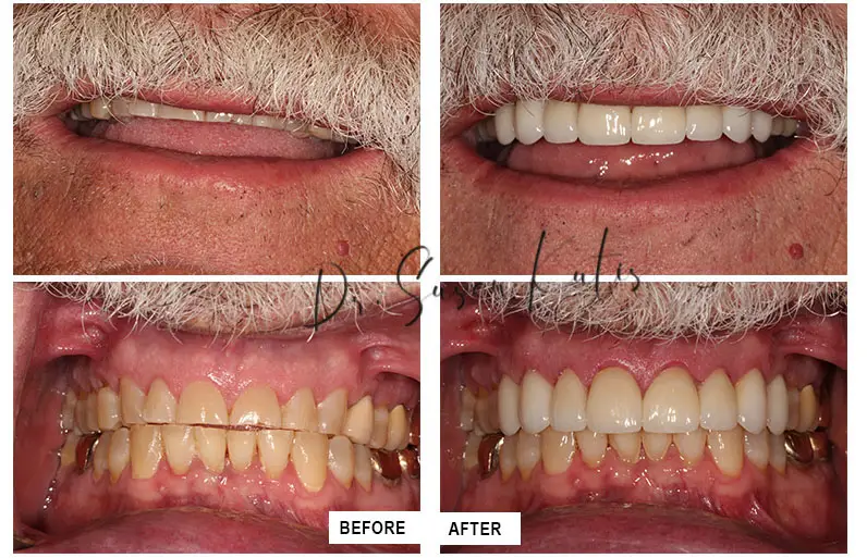Worn Teeth Littleton