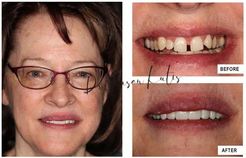 Fillings LIttleton