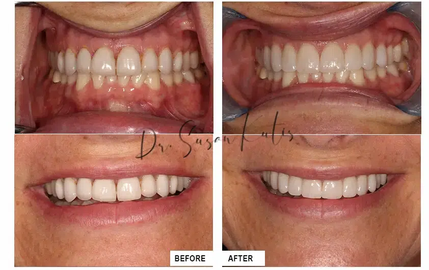 Cosmetic Dentistry Gallery Littleton