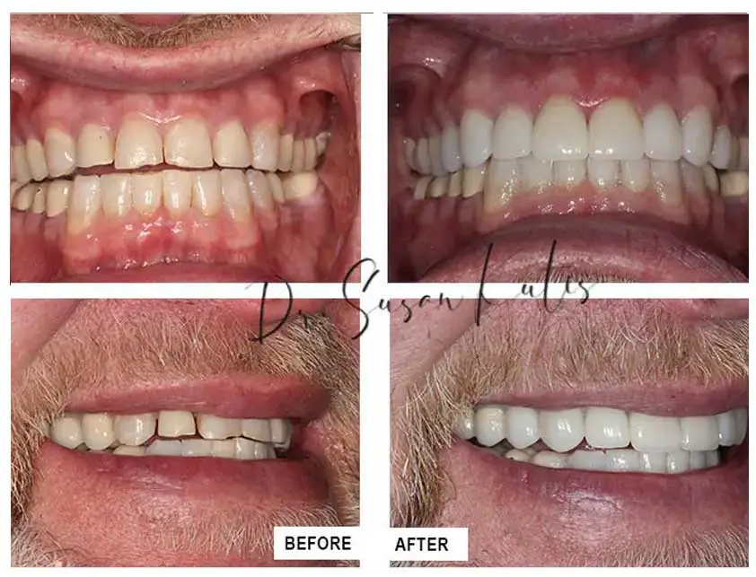 Worn Teeth Gallery Littleton