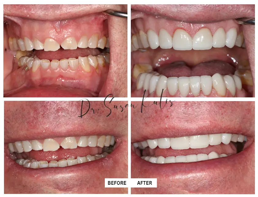 Worn Teeth Gallery Littleton