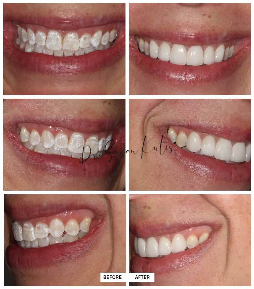 Tetracycline Staining Gallery Littleton