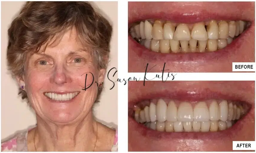 Cosmetic Dentistry Gallery Littleton