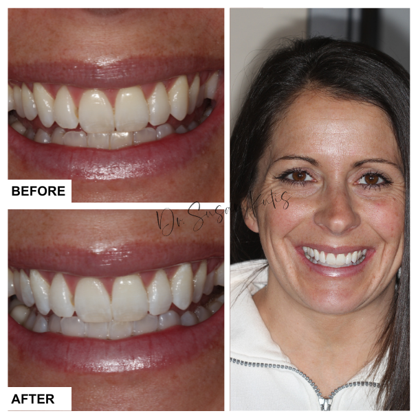 Teeth Whitening Littleton