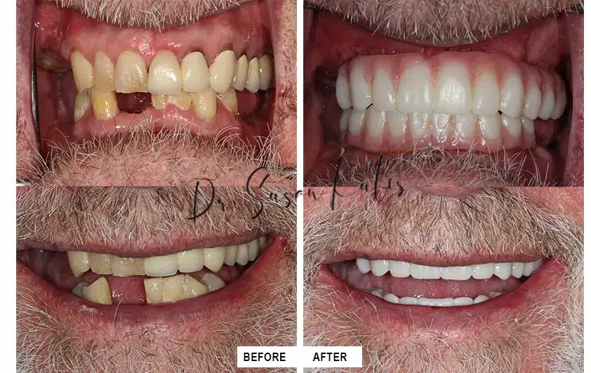Dental Implants Littleton