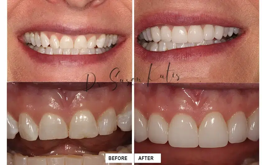 Cosmetic Dentistry Gallery LIttleton