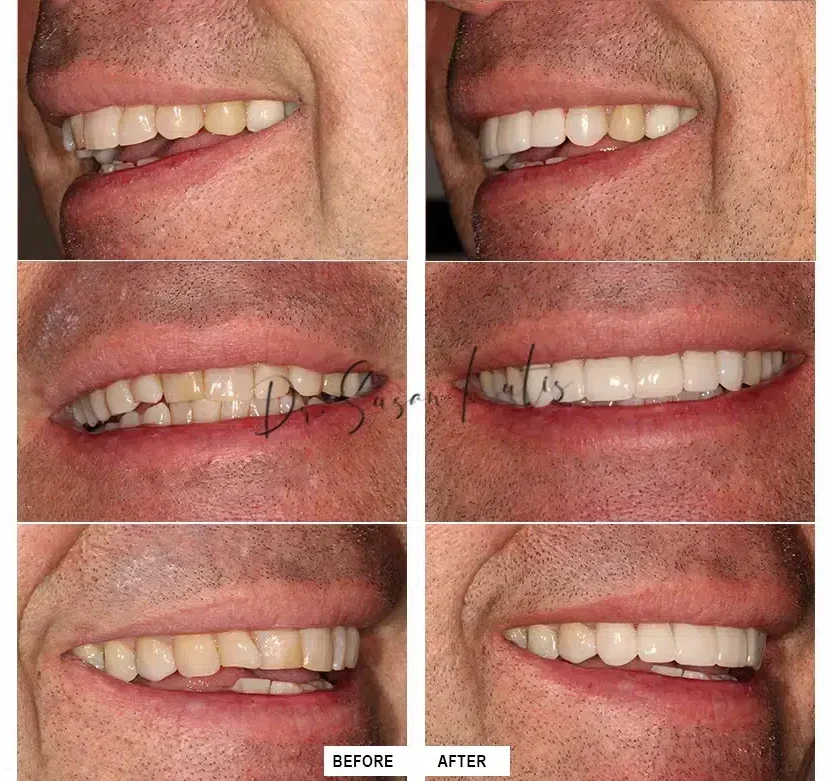 dental crowns littleton