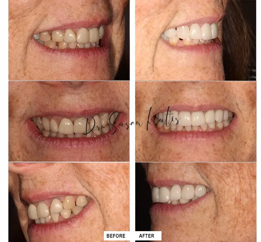 Fillings Littleton