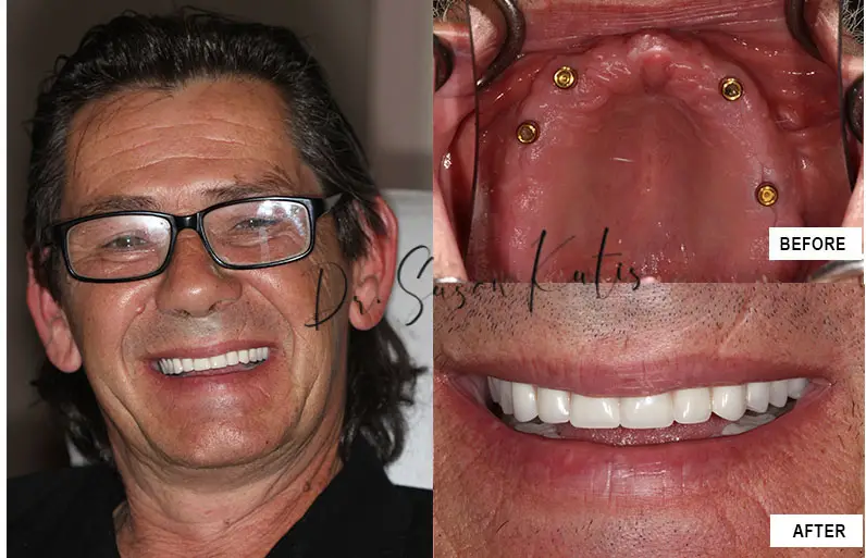 Dental Implants Littleton