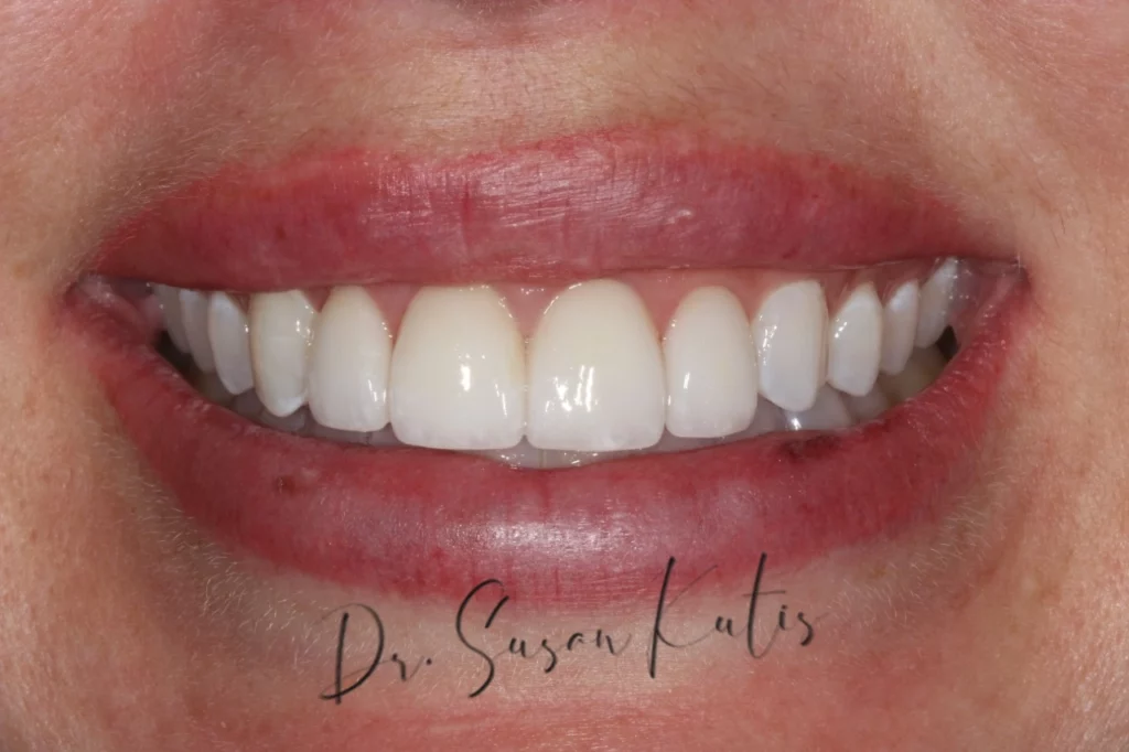 Invisalign Littleton