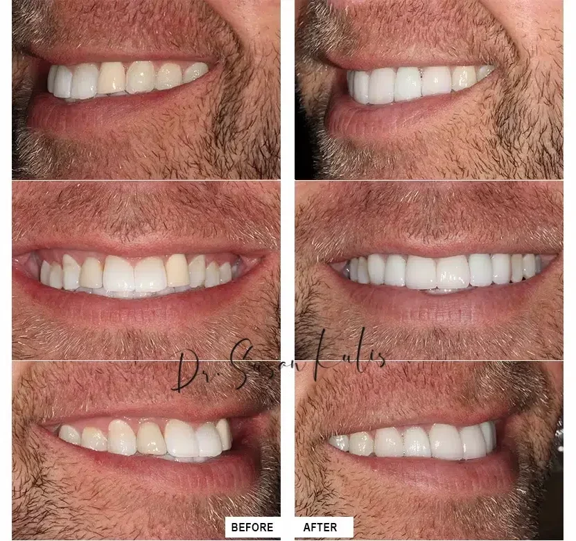 dental implants littleton