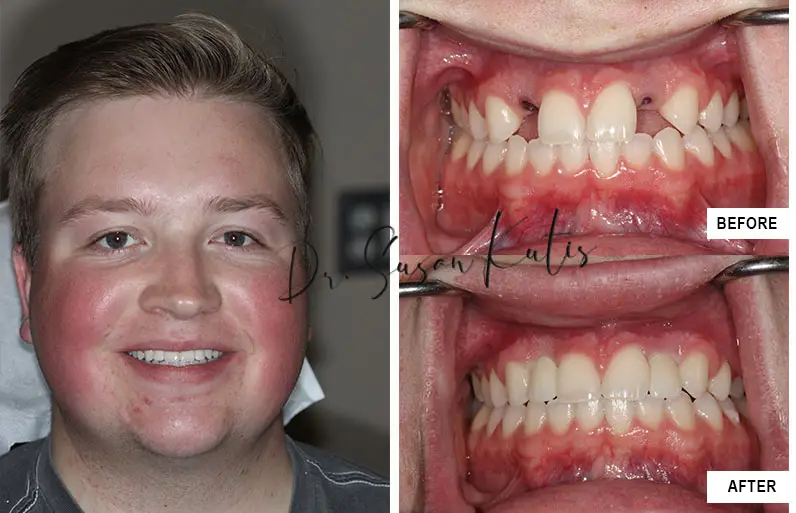 Dental Implants Littleton