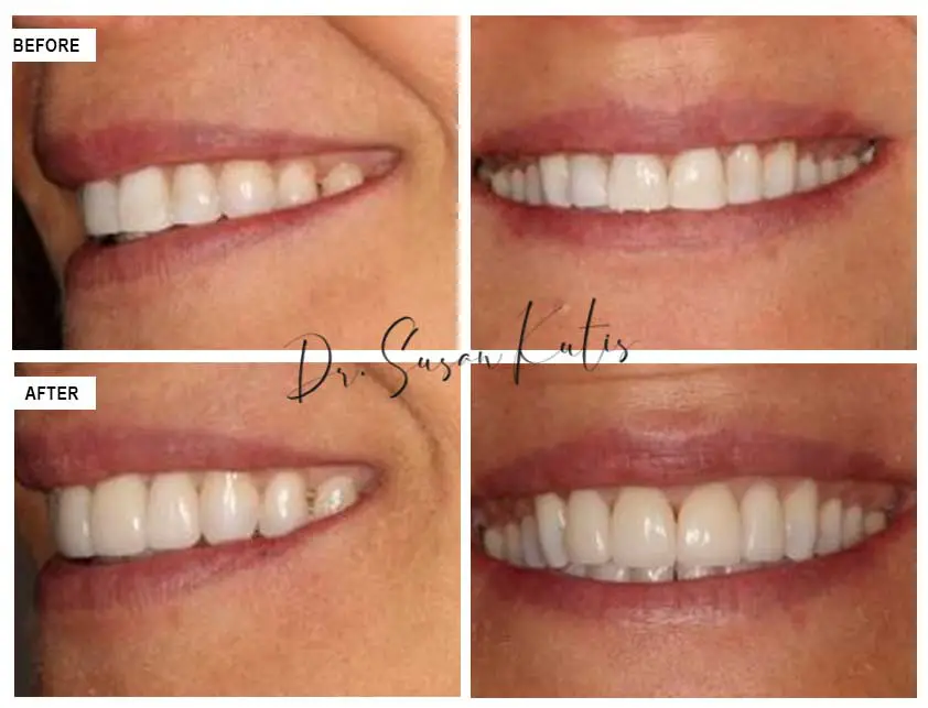 Invisalign Littleton