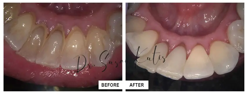 Teeth Cleaning Littleton