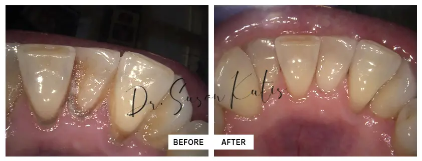 Teeth Cleaning Littleton